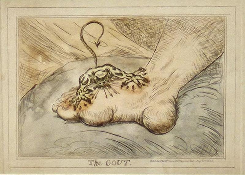The Gout Hand Colored Engraving England 1835